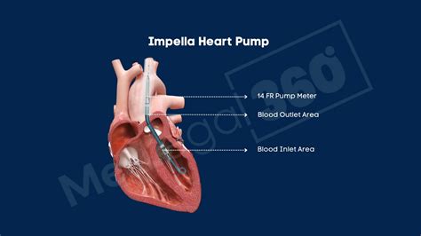 bills a screw pump heart|Impella Heart Pump .